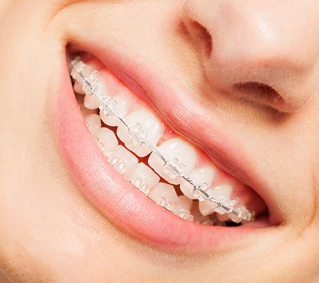 Babylon Invisible Orthodontics