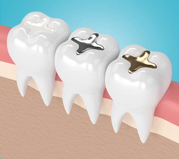 Babylon Tooth Colored Fillings