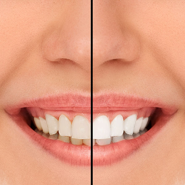 Learn About Professional Teeth Whitening Brands